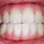 Entzündung des Zahnfleisches