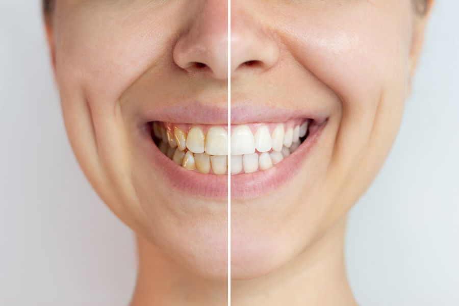 Bleaching - Vorher-Nachher-Vergleichsbild